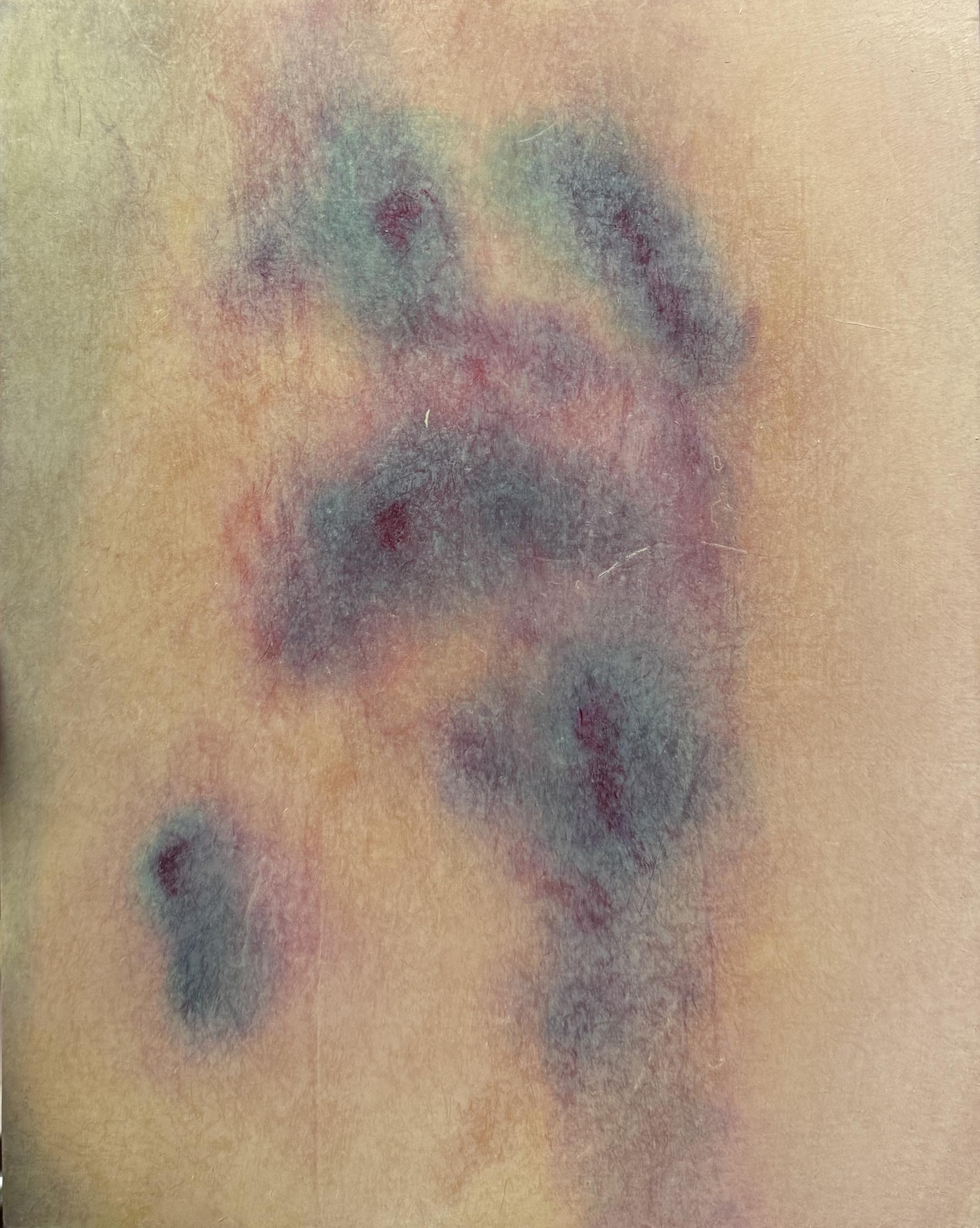 Koda-Smith_Bruise-15_2026