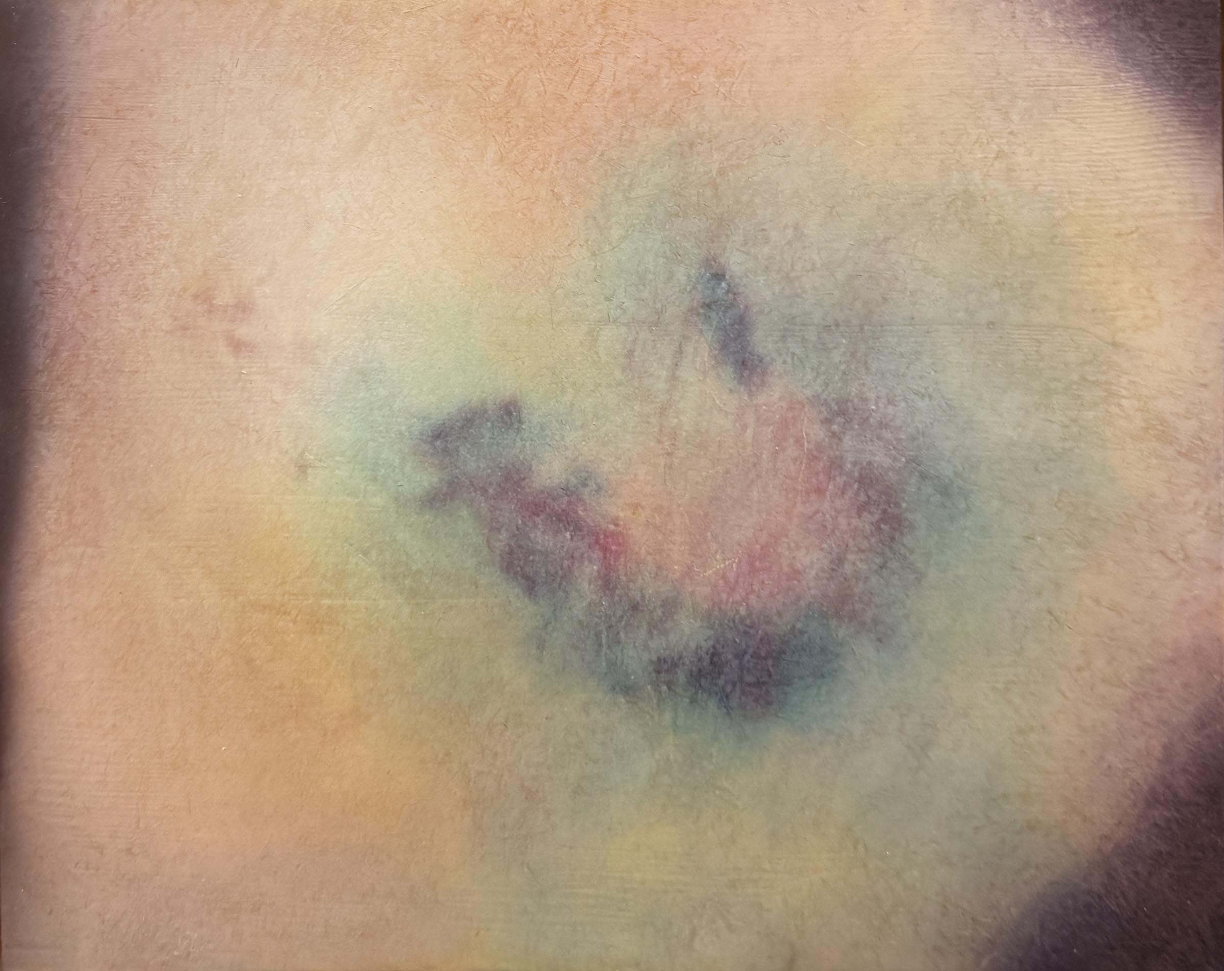 Koda-Smith_Bruise-16_2026